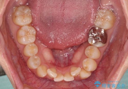 【モニター】前歯のデコボコとクロスバイト インビザラインによる矯正治療の治療前
