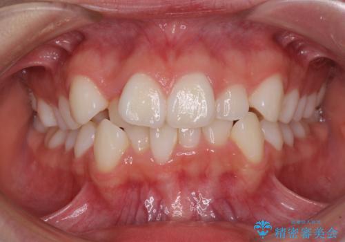 前歯のデコボコとクロスバイトを治したい　ワイヤー装置による抜歯矯正の症例 治療前