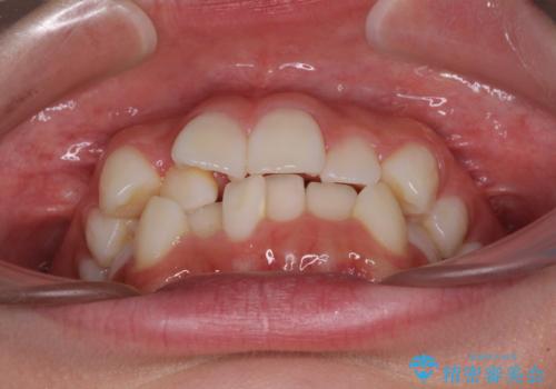 前歯のデコボコとクロスバイトを治したい ワイヤー装置による抜歯矯正の治療前