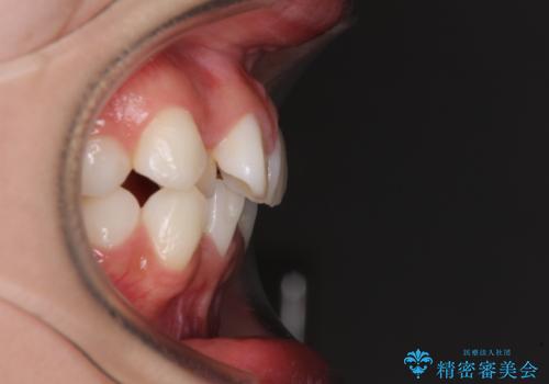 前歯のデコボコとクロスバイトを治したい ワイヤー装置による抜歯矯正の治療前