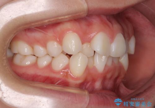 前歯のデコボコとクロスバイトを治したい ワイヤー装置による抜歯矯正の治療前