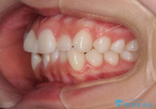 前歯のデコボコとクロスバイトを治したい　ワイヤー装置による抜歯矯正の治療前