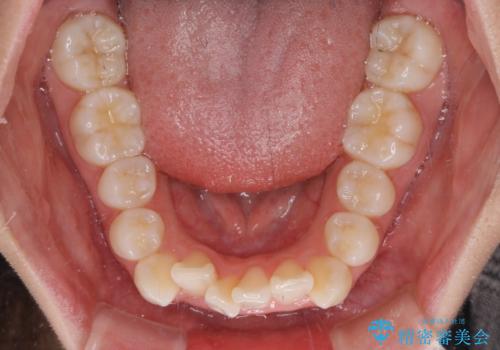 前歯のデコボコとクロスバイトを治したい ワイヤー装置による抜歯矯正の治療前