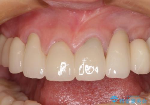 割れてしまった歯が痛む 矯正とインプラントを併用した総合歯科治療の治療後