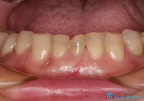 割れてしまった歯が痛む 矯正とインプラントを併用した総合歯科治療の治療後