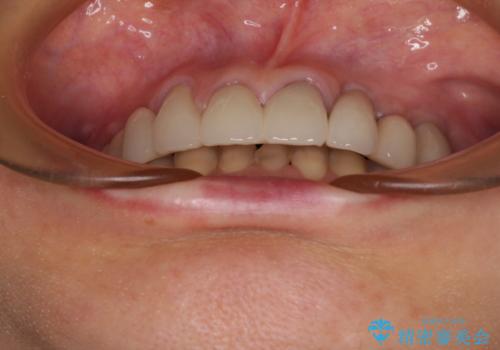 割れてしまった歯が痛む 矯正とインプラントを併用した総合歯科治療の治療後