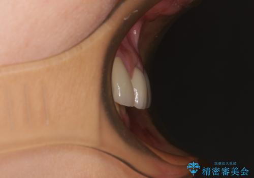 割れてしまった歯が痛む 矯正とインプラントを併用した総合歯科治療の治療後