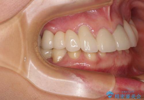 割れてしまった歯が痛む 矯正とインプラントを併用した総合歯科治療の治療後