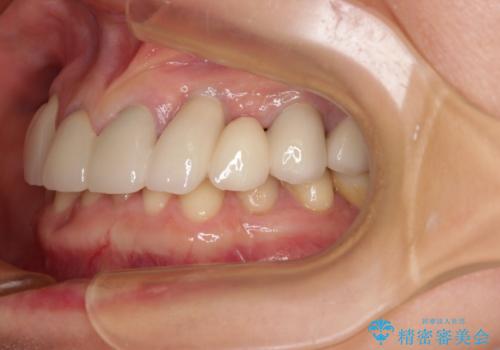 割れてしまった歯が痛む 矯正とインプラントを併用した総合歯科治療の治療後