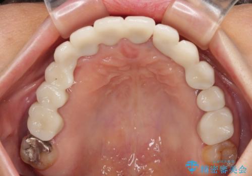 割れてしまった歯が痛む 矯正とインプラントを併用した総合歯科治療の治療後