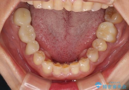 割れてしまった歯が痛む 矯正とインプラントを併用した総合歯科治療の治療後