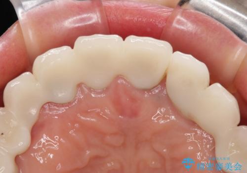 割れてしまった歯が痛む 矯正とインプラントを併用した総合歯科治療の治療後