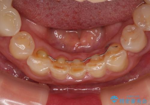 割れてしまった歯が痛む 矯正とインプラントを併用した総合歯科治療の治療後