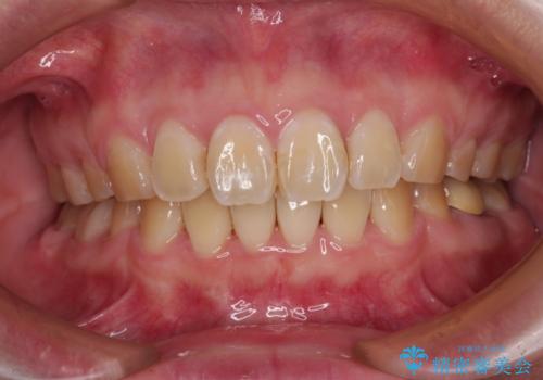 抜歯矯正で唇を閉じやすく ワイヤー矯正の症例 治療後
