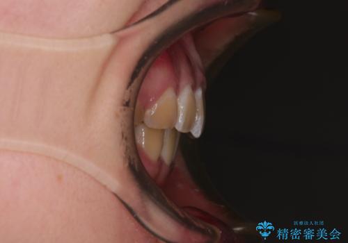 抜歯矯正で唇を閉じやすく ワイヤー矯正の治療後