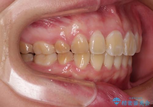 抜歯矯正で唇を閉じやすく ワイヤー矯正の治療後