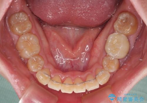 抜歯矯正で唇を閉じやすく ワイヤー矯正の治療後