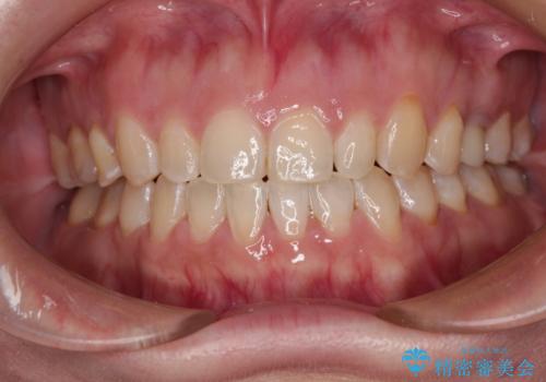 隙間の空いた歯列とボロボロの乳歯　インプラント治療と矯正治療の症例 治療後