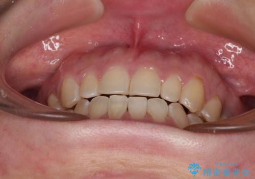 隙間の空いた歯列とボロボロの乳歯 インプラント治療と矯正治療の治療後