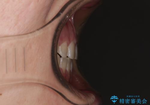 隙間の空いた歯列とボロボロの乳歯 インプラント治療と矯正治療の治療後