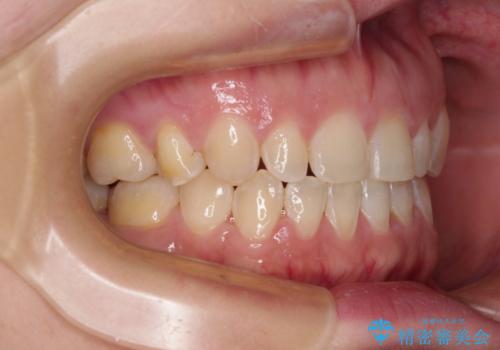 隙間の空いた歯列とボロボロの乳歯 インプラント治療と矯正治療の治療後