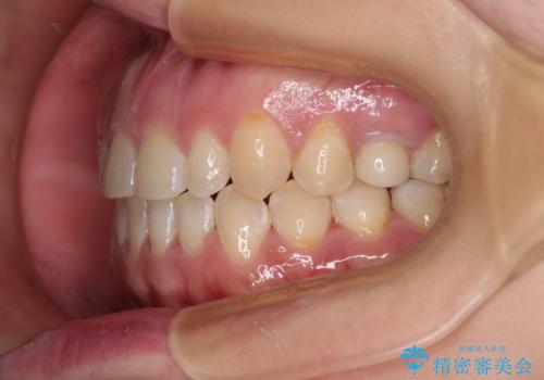 隙間の空いた歯列とボロボロの乳歯　インプラント治療と矯正治療の治療後