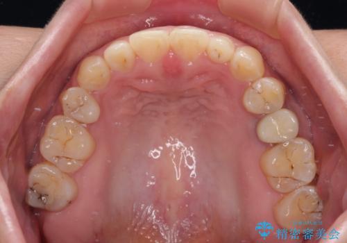 隙間の空いた歯列とボロボロの乳歯　インプラント治療と矯正治療の治療後
