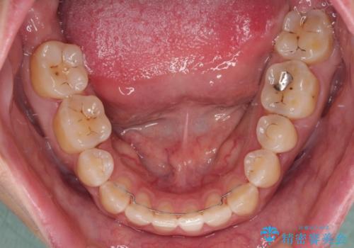 隙間の空いた歯列とボロボロの乳歯 インプラント治療と矯正治療の治療後