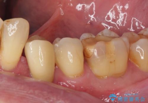 根元で折れてしまった歯を何とか保存する　部分矯正と補綴治療の症例 治療後