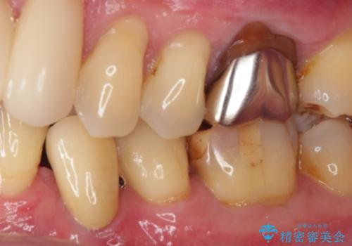 根元で折れてしまった歯を何とか保存する 部分矯正と補綴治療