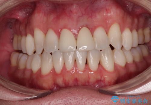 他院で矯正治療中 変色した前歯のオールセラミッククラウン治療の治療後