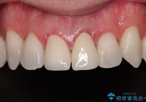 他院で矯正治療中 変色した前歯のオールセラミッククラウン治療の症例 治療後