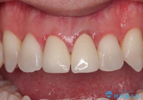 他院で矯正治療中 変色した前歯のオールセラミッククラウン治療の治療後