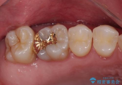 他院で矯正治療中 変色した前歯のオールセラミッククラウン治療の治療後