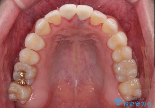 他院で矯正治療中 変色した前歯のオールセラミッククラウン治療の治療後
