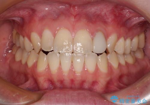 開咬を治す インビザラインによる矯正治療の症例 治療後