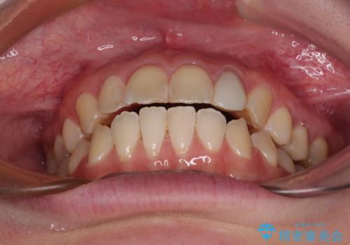 開咬を治す インビザラインによる矯正治療の治療後