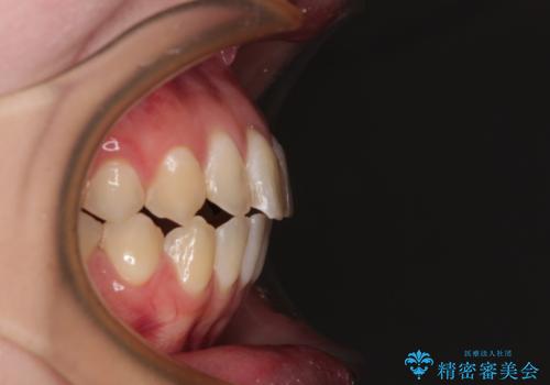 開咬を治す インビザラインによる矯正治療の治療後