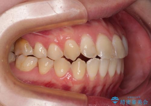 開咬を治す インビザラインによる矯正治療の治療後