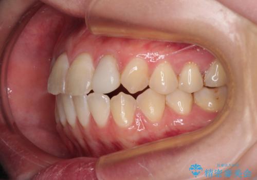 開咬を治す インビザラインによる矯正治療の治療後