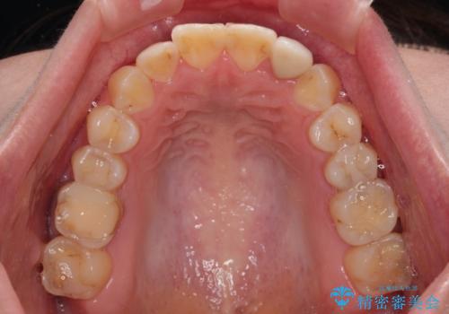 開咬を治す インビザラインによる矯正治療の治療後