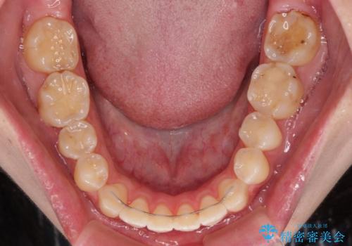 開咬を治す インビザラインによる矯正治療の治療後