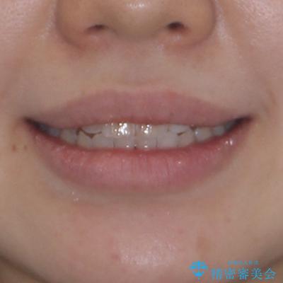 開咬を治す　インビザラインによる矯正治療の治療後（顔貌）