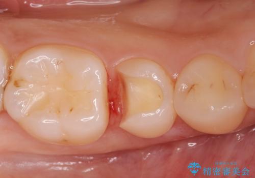 [e-maxインレー] 矯正治療前の虫歯治療の治療中