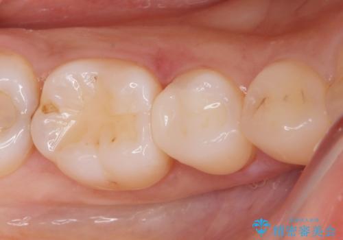 [e-maxインレー] 矯正治療前の虫歯治療の治療後