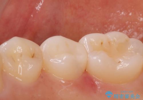 [e-maxインレー] 矯正治療前の虫歯治療の治療後