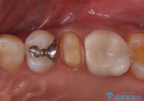 【根管治療・オールセラミッククラウン】何もしなくても歯が痛い 咬むと更に痛いの治療中