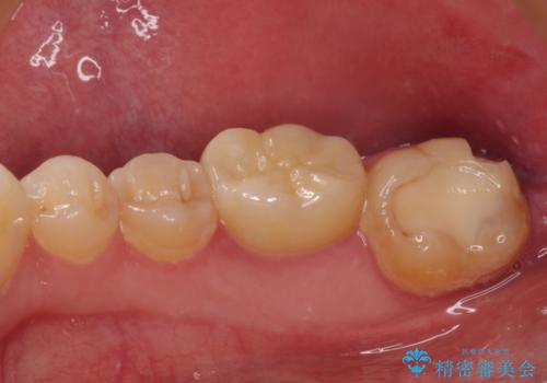 海外赴任前に間に合わせたい 内部でむし歯が進行した奥歯の補綴治療の治療前