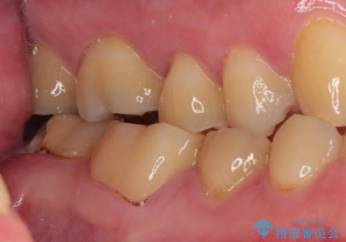 海外赴任前に間に合わせたい 内部でむし歯が進行した奥歯の補綴治療の治療前