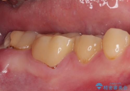 海外赴任前に間に合わせたい 内部でむし歯が進行した奥歯の補綴治療の治療前